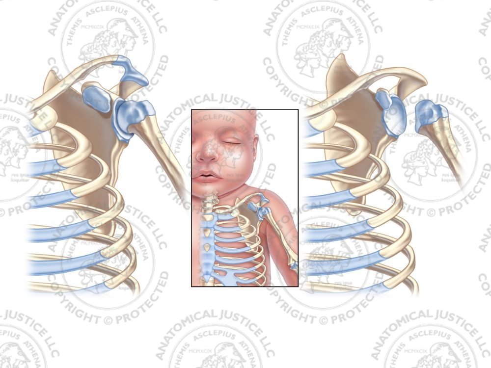 Infant Left Shoulder Deformity – No Text