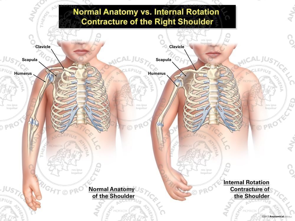 Normal Anatomy vs. Internal Rotation Contracture of the Right Shoulder