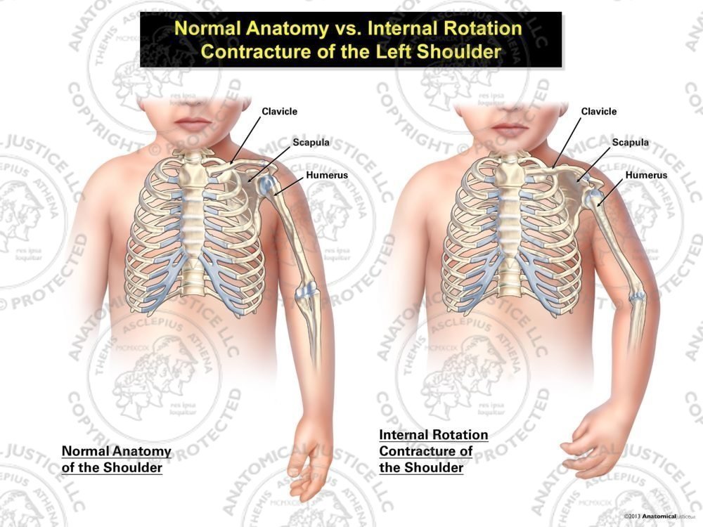 Normal Anatomy vs. Internal Rotation Contracture of the Left Shoulder