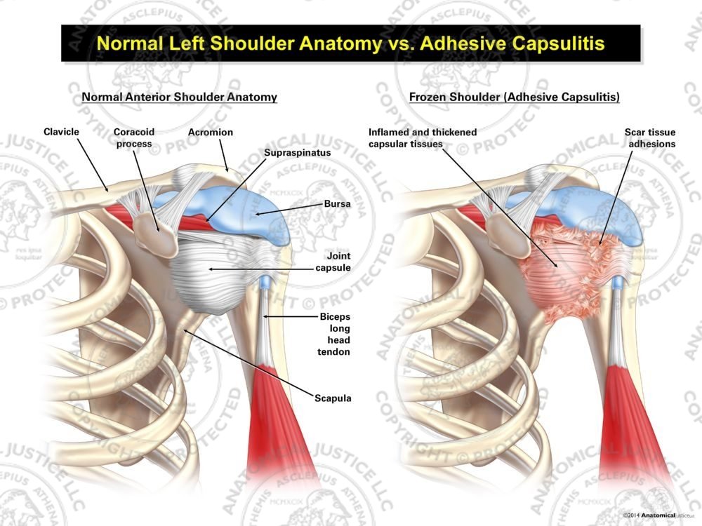 Normal Left Shoulder Anatomy vs. Adhesive Capsulitis