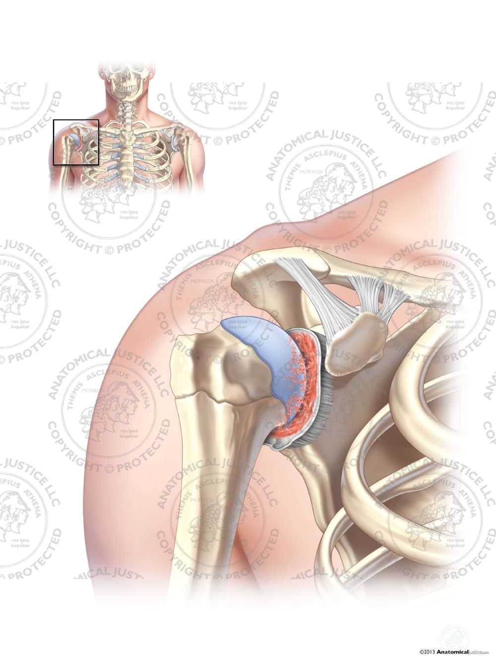 Synovitis of the Right Shoulder – No Text