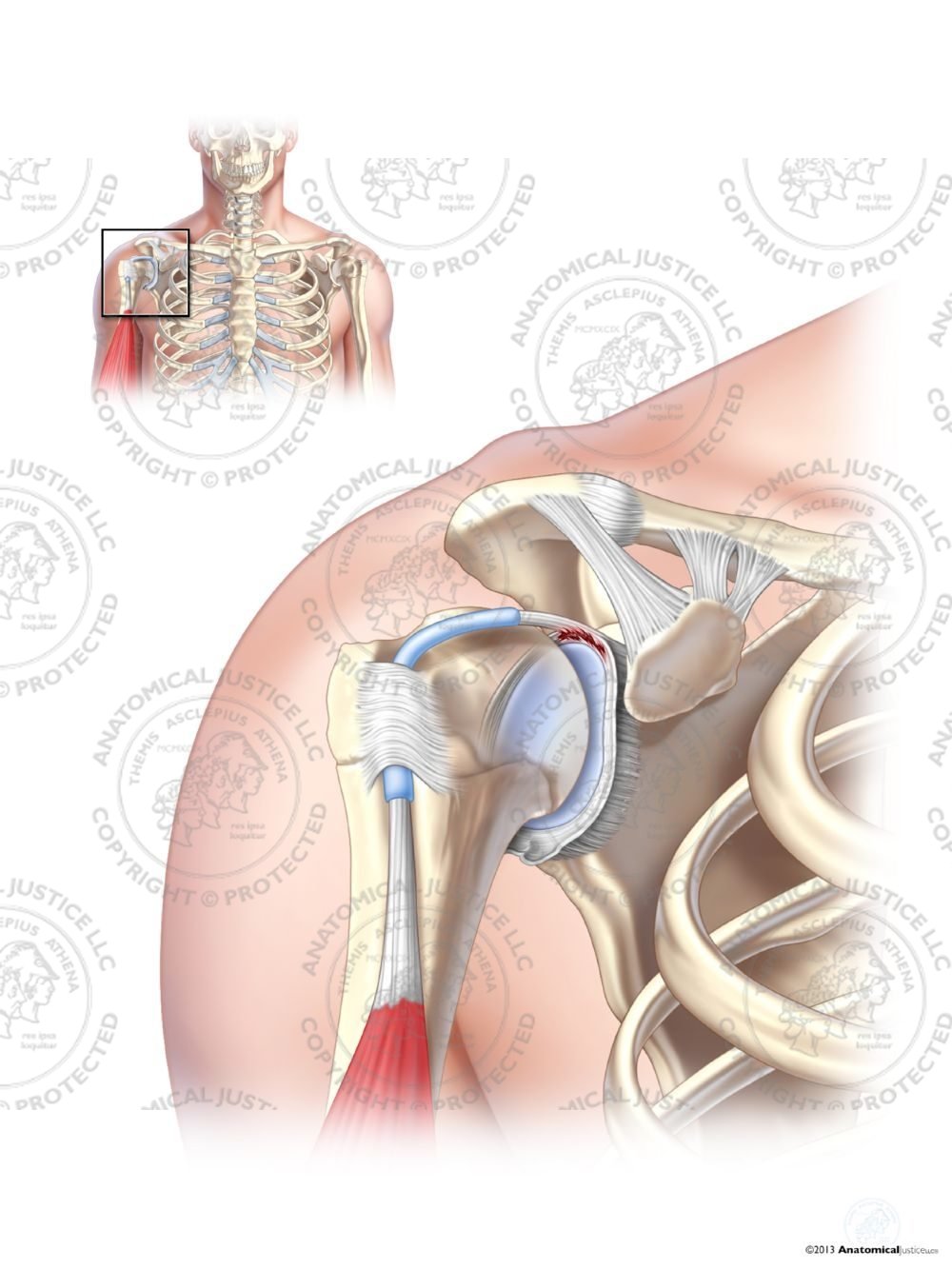 Type I SLAP Tear of the Right Labrum – No Text