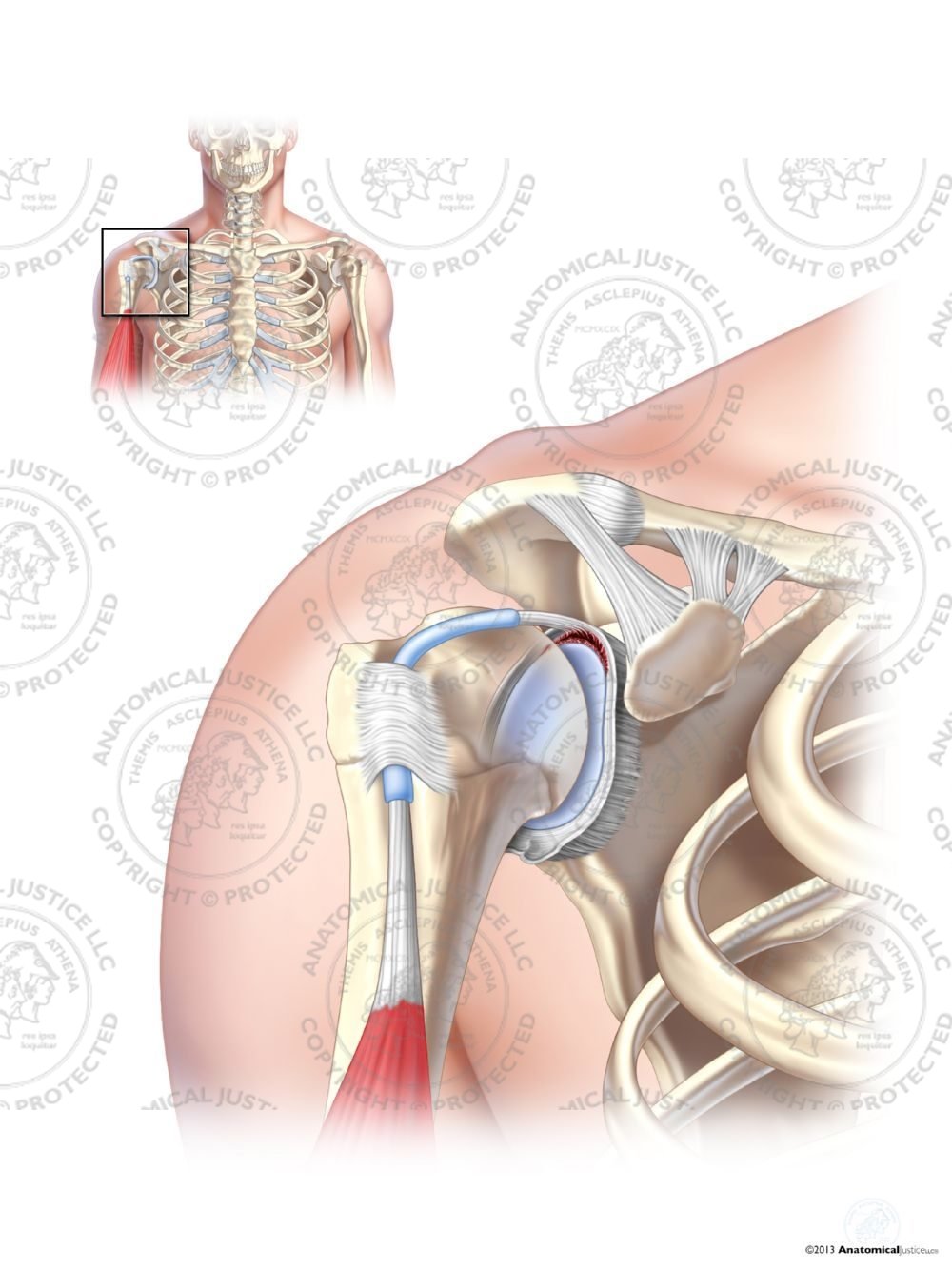 Type II SLAP Tear of the Right Labrum – No Text