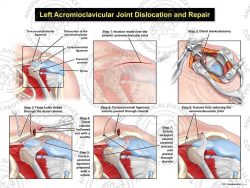 Left Acromioclavicular Joint Dislocation and Repair