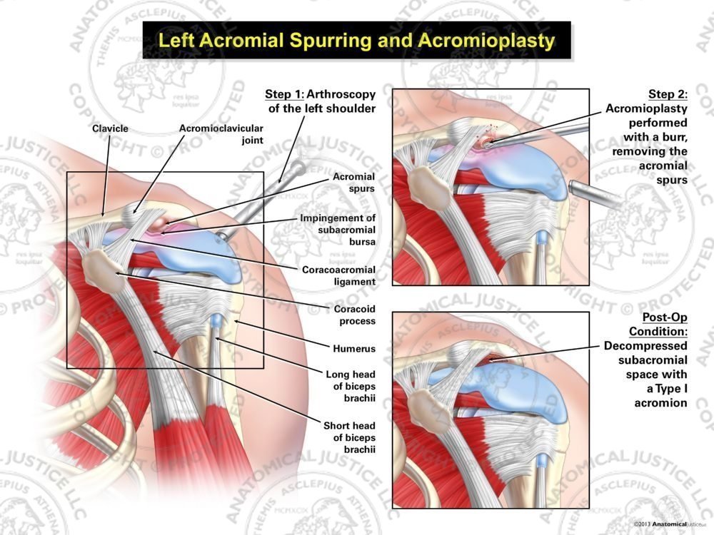Left Acromial Spurring and Acromioplasty
