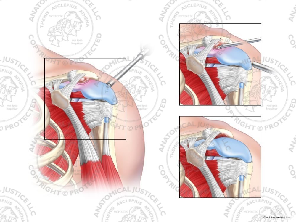 Left Acromial Spurring and Acromioplasty – No Text