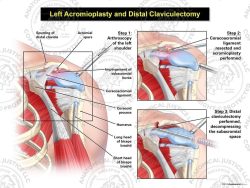 Left Acromioplasty and Distal Claviculectomy