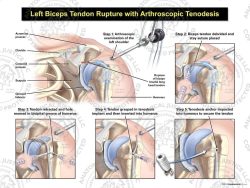 Left Biceps Rupture with Arthroscopic Tenodesis