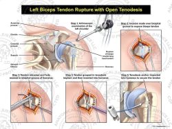 Left Biceps Rupture with Open Tenodesis