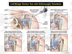 Left Biceps Tear with Arthroscopic Tenodesis