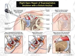 Right Open Repair of Supraspinatus Avulsion with a Suture Anchor