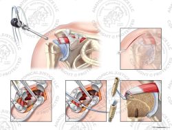 Right Open Two Anchor Knotless Double Row Repair of Supraspinatus Avulsion – No Text