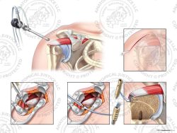 Right Open Two Anchor Knotless Double Row Repair of Chronic Supraspinatus Tear – No Text