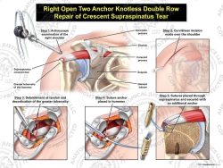Right Open Two Anchor Knotless Double Row Repair of Crescent Supraspinatus Tear