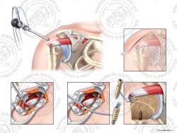 Right Open Two Anchor Knotless Double Row Repair of Irregular Supraspinatus Tear – No Text