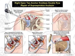 Right Open Two Anchor Knotted Double Row Repair of Supraspinatus Avulsion