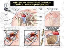 Right Open Two Anchor Knotted Double Row Repair of Crescent Supraspinatus Tear