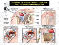 Right Open Two Anchor Knotted Double Row Repair of Irregular Supraspinatus Tear