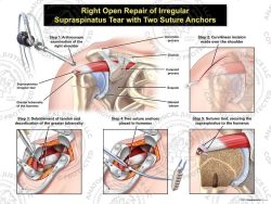 Right Open Repair of Irregular Supraspinatus Tear with Two Suture Anchors