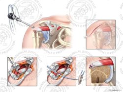 Right Open Repair of Irregular Supraspinatus Tear with Two Suture Anchors – No Text