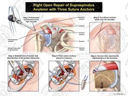 Right Open Repair of Supraspinatus Avulsion with Three Suture Anchors