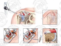 Right Open Repair of Supraspinatus Avulsion with Three Suture Anchors – No Text