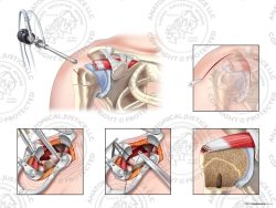 Right Open Repair of Supraspinatus Avulsion with Four Sutures – No Text