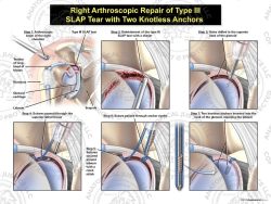 Right Arthroscopic Repair of Type III SLAP Tear with Two Knotless Anchors
