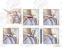 Left Arthroscopic Repair of Type III SLAP Tear with a Suture Anchor