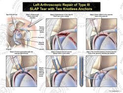 Left Arthroscopic Repair of Type III SLAP Tear with Two Knotless Anchors
