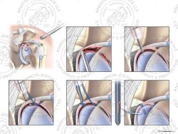 Left Arthroscopic Repair of Type III SLAP Tear with Two Knotless Anchors – No Text
