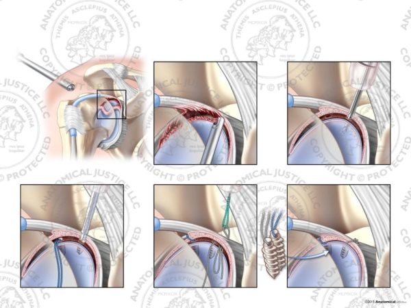 Arthroscopic Repair of Type III SLAP Tear with Two Suture Anchors
