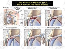 Left Arthroscopic Repair of Type III SLAP Tear with Two Suture Anchors