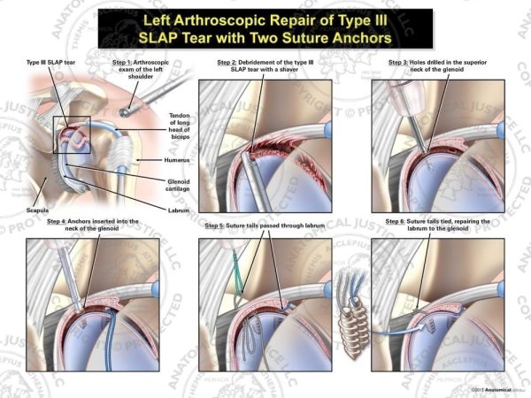 Arthroscopic Repair of Type III SLAP Tear with Two Suture Anchors