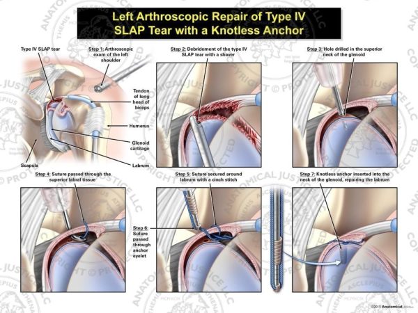 Arthroscopic Repair of Type IV SLAP Shoulder Tear with a Knotless Anchor