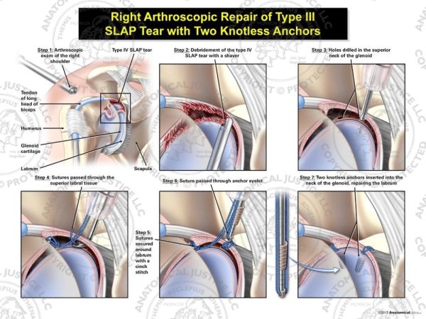 Arthroscopic Repair of Type IV Superior Labral Tear Anterior To Posterior (SLAP) Tear with Two Knotless Anchors