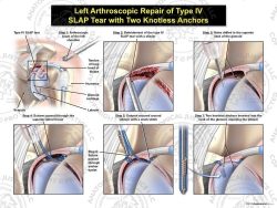 Left Arthroscopic Repair of Type IV SLAP Tear with Two Knotless Anchors