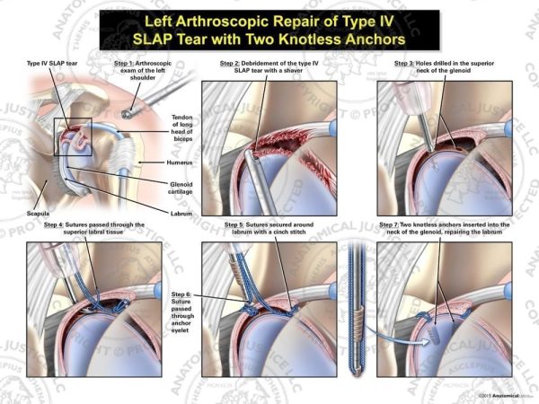 Arthroscopic Repair of Type IV SLAP Tear with Two Knotless Anchors