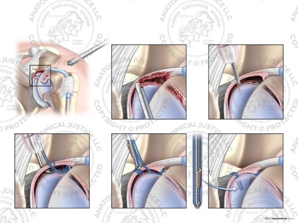 Arthroscopic Repair of Type IV SLAP Labrum Tear with Two Knotless Anchors