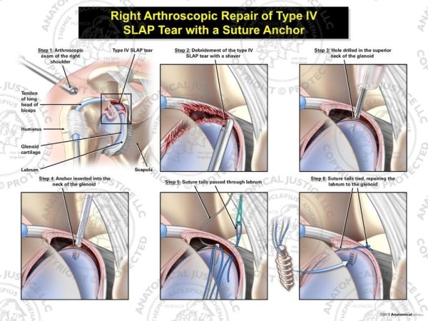 Arthroscopic Repair of Type IV SLAP Tear with a Suture Anchor