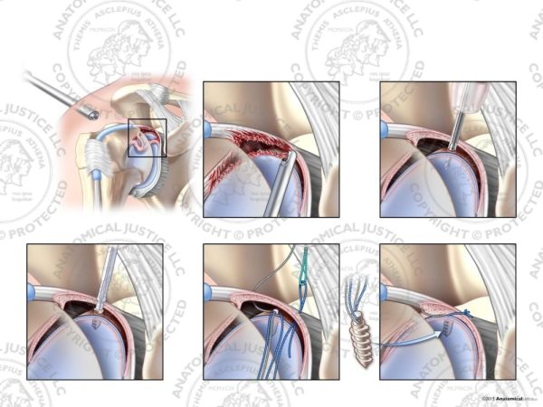 Arthroscopic Repair of Type IV SLAP Shoulder Tear with a Suture Anchor