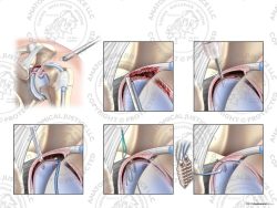 Left Arthroscopic Repair of Type IV SLAP Tear with Two Suture Anchors – No Text