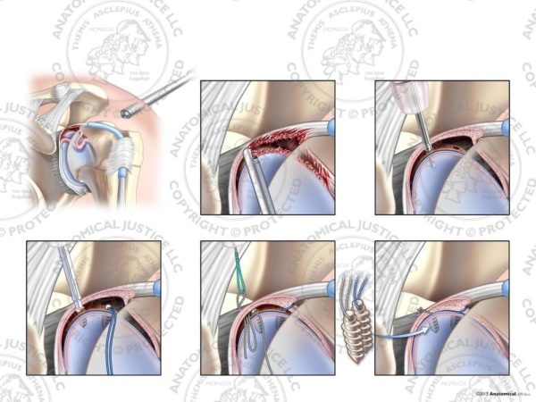 Arthroscopic Repair of Type IV SLAP Tear with Two Suture Anchors