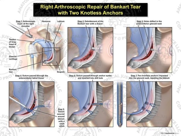 Right Arthroscopic Repair of Bankart Lesion with Two Knotless Anchors