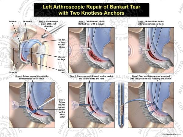 Left Arthroscopic Repair of Bankart Lesion with Two Knotless Anchors