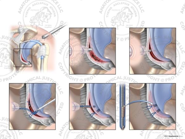 Left Arthroscopic Repair of Bankart Lesion with Two Knotless Anchors