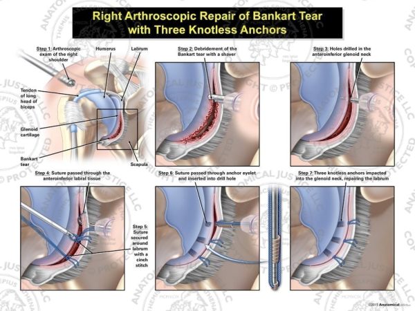 Right Arthroscopic Repair of Bankart Lesion with Three Knotless Anchors
