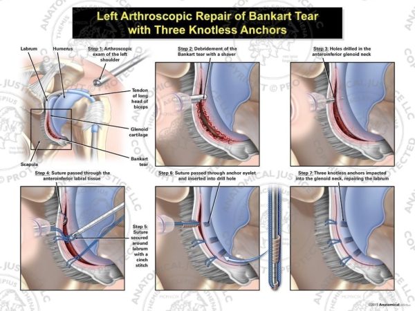 Left Arthroscopic Repair of Bankart Lesion with Three Knotless Anchors