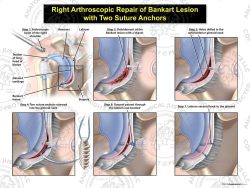 Right Arthroscopic Repair of Bankart Lesion with Two Suture Anchors