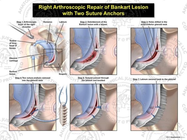 Arthroscopic Right Bankart Lesion Repair with Two Suture Anchors